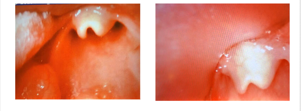 Epiglottis Control 2