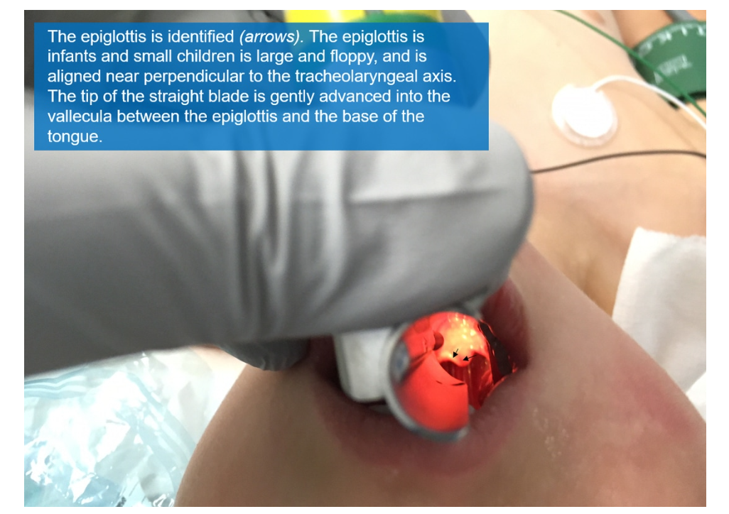Epiglottis Control