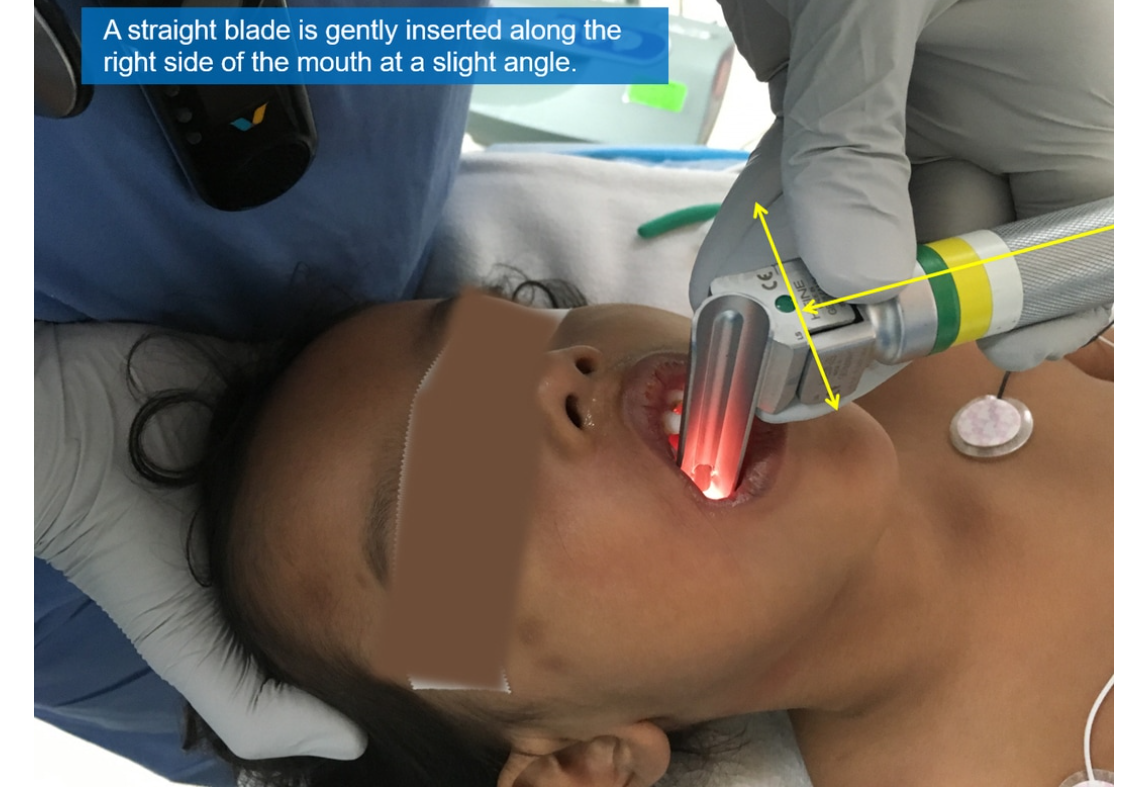 Laryngoscope Insertion